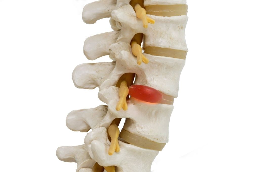 hernia discal