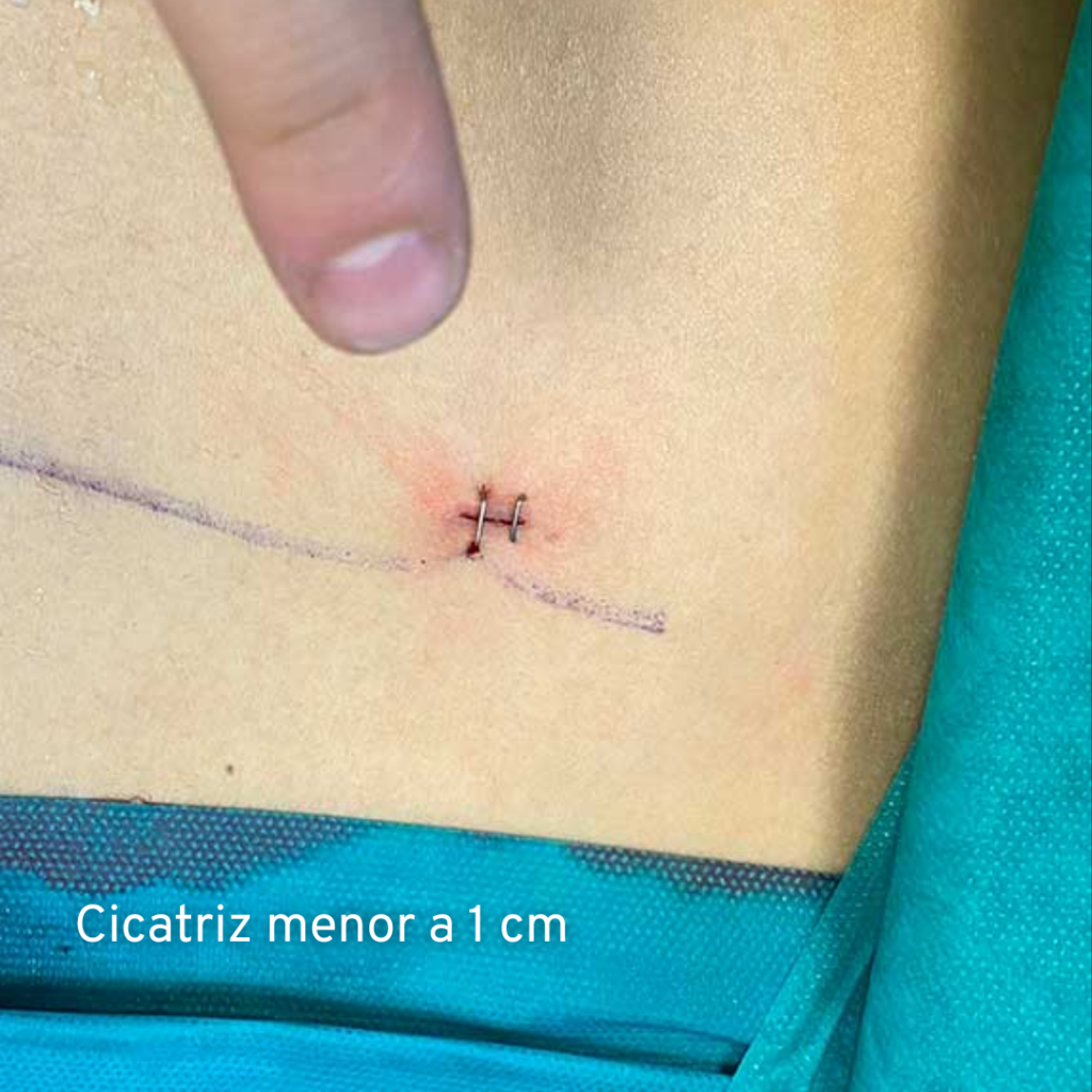 operacion-hernia-discal-malaga-andalucia